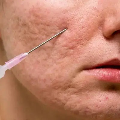 Acne scar treatment with needle image on Dysmenorrhea Tea promoting blood circulation herbal tea