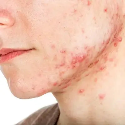 Acne-covered face showcasing herbal tea for cramps that alleviates menstrual pain and promotes blood circulation