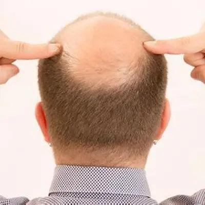 Balding head with fingers pointing, promoting Sleep Tea for better sleep quality herbal tea